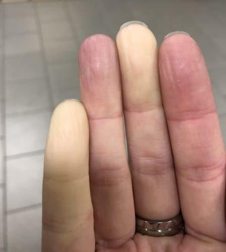 Raynauds syndrom, vita fingrar